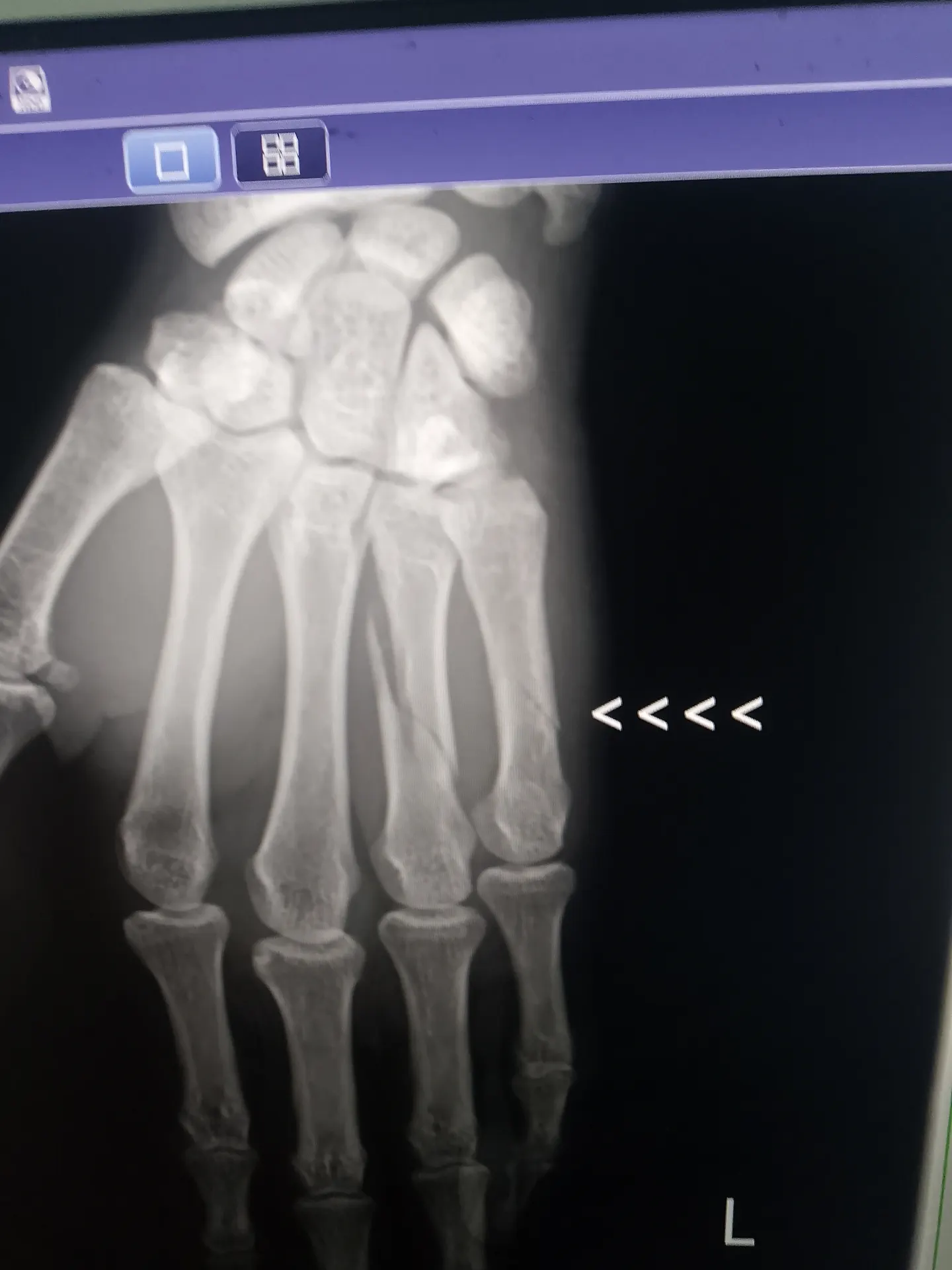 SUDAN STRIKER SAIFELDIN MALIK BAKHIT SUFFERS HAND FRACTURE